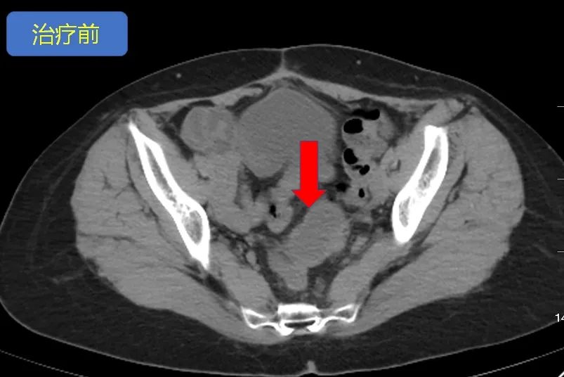 卵巢癌出现肠梗阻怎么治疗,卵巢癌晚期肠梗阻怎么治疗