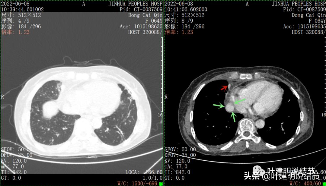 这位老乡，乏力来查，查出这么大个的纵隔肿瘤！会是什么呢？