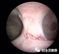 妇科专家教你认识宫腔镜,宫腔镜妇科主任