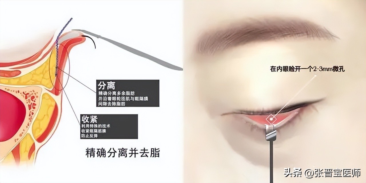 去眼袋手术后期变老,去眼袋手术的真实感受