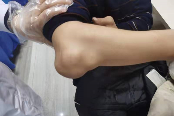 身上长出“疙瘩”一定是痛风？可能是类风湿结节