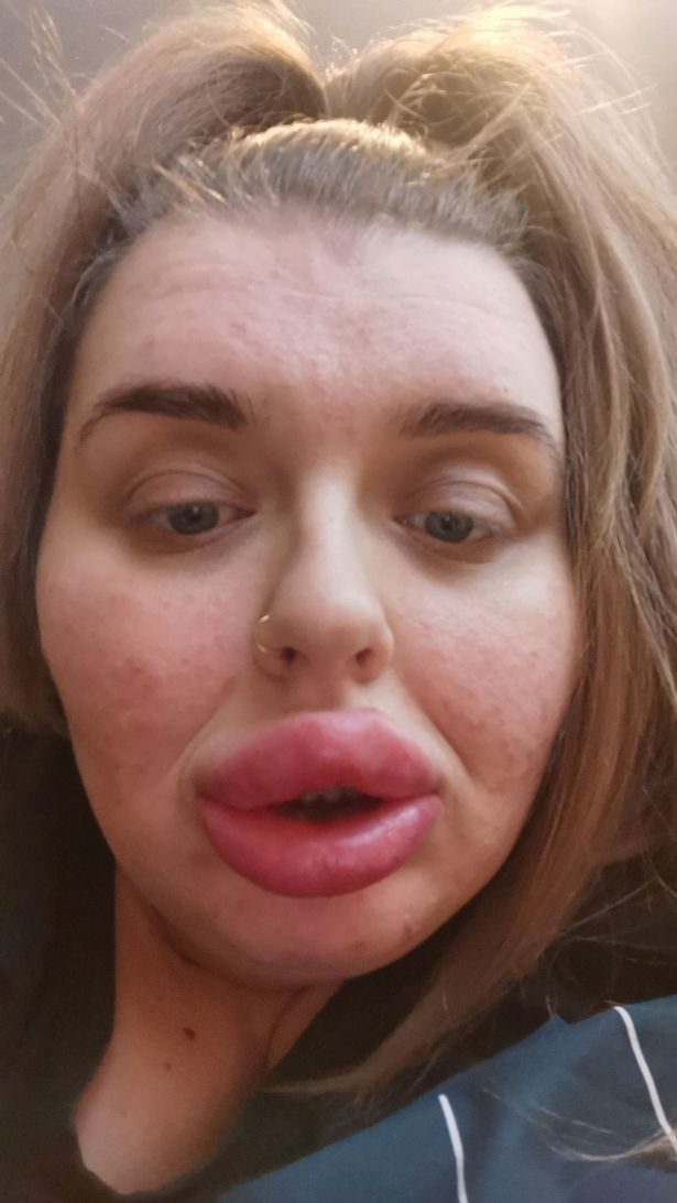 英国女子整容后做8次手术保命,丰唇手术后变成香肠嘴
