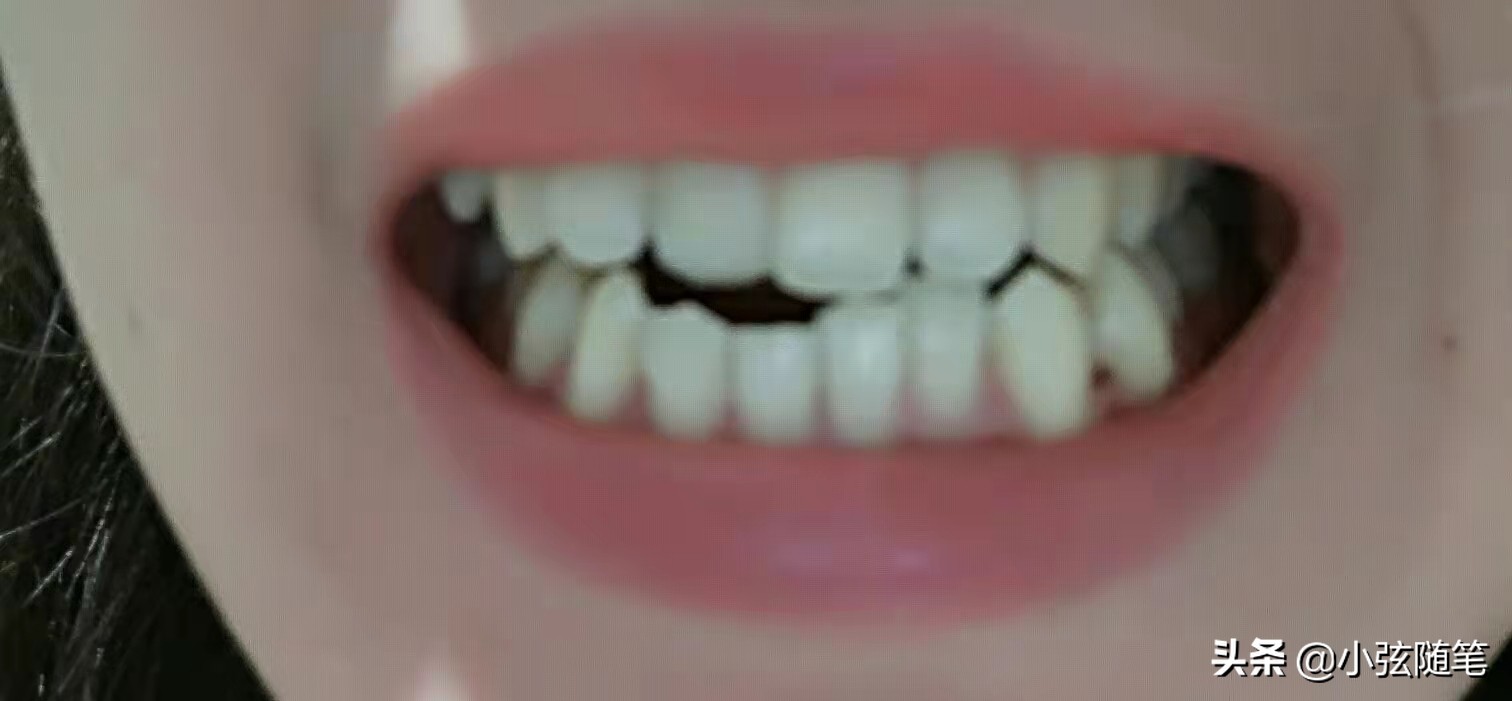 隐形矫正牙齿一万多,牙齿矫正和隐形牙齿矫正的全过程