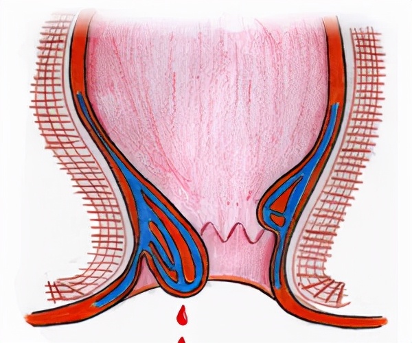 大便带血对身体有什么危害,大便带血什么问题