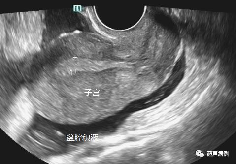 做阴道B超是一种什么样的体验？