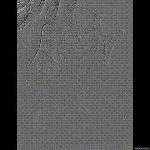 病例回顾与分享,腹膜后血肿介入治疗