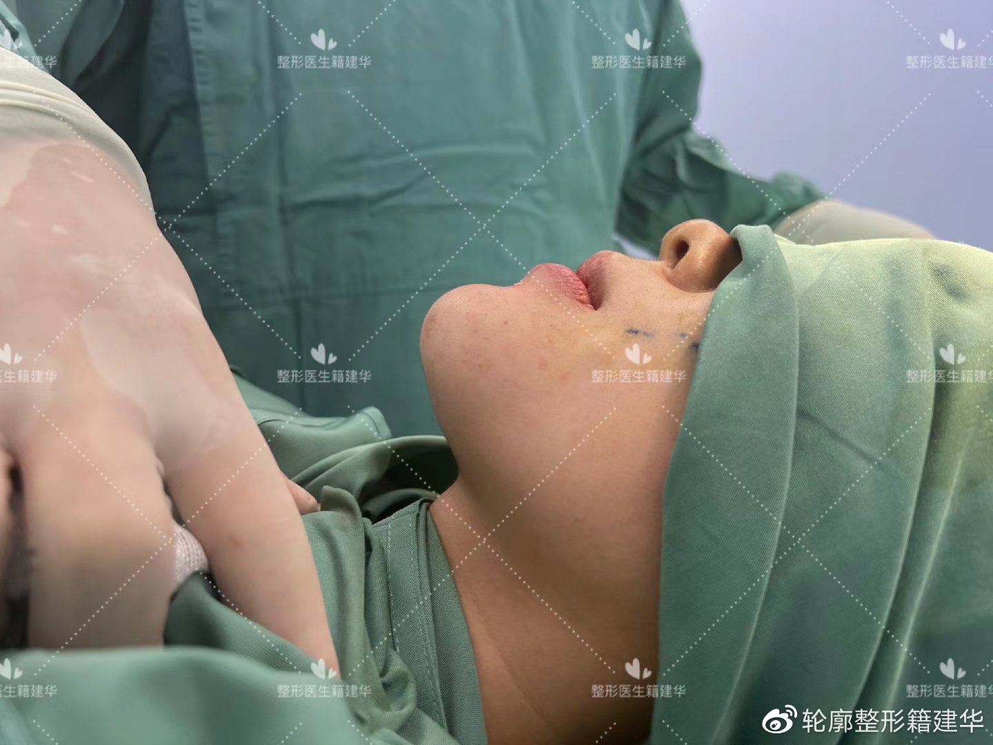 下巴后缩要怎么整形,下巴后缩做什么手术矫正