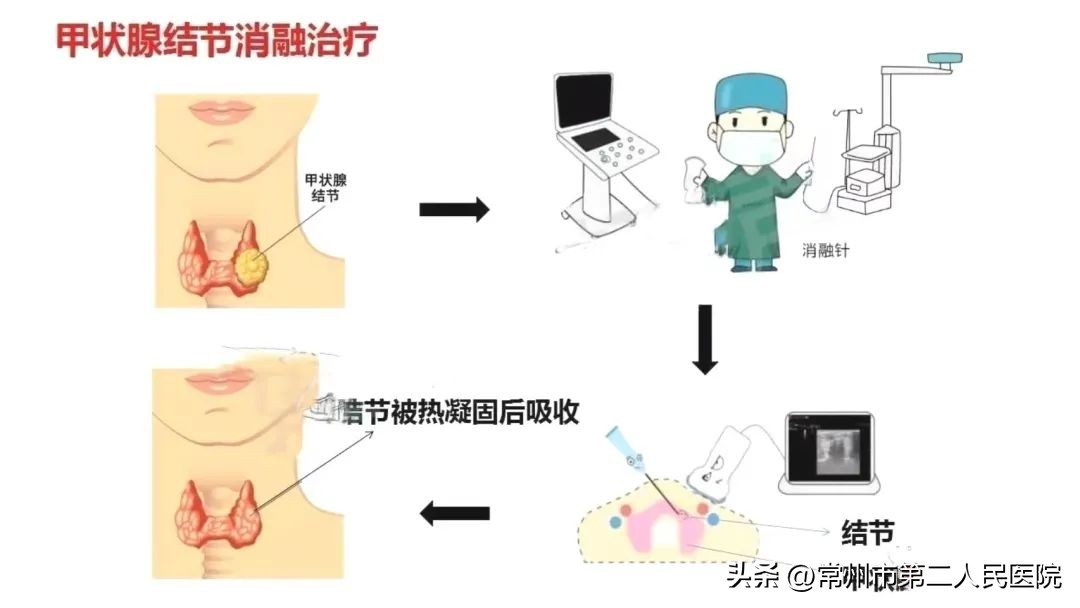 小针孔，用途多，漫画带你了解介入超声能做啥？