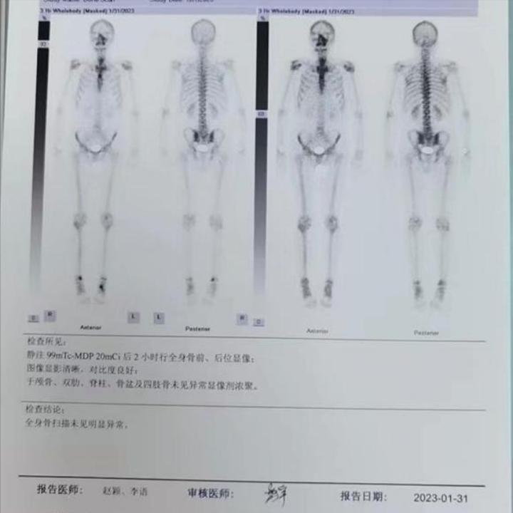 周围型肺癌最好的治疗方法,周围型肺癌早期治愈的可能性大吗