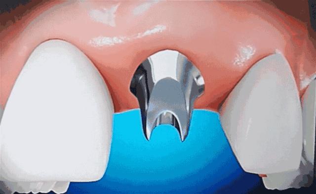 牙齿掉了对其他的牙齿有影响吗,牙齿掉了三个月没有出牙