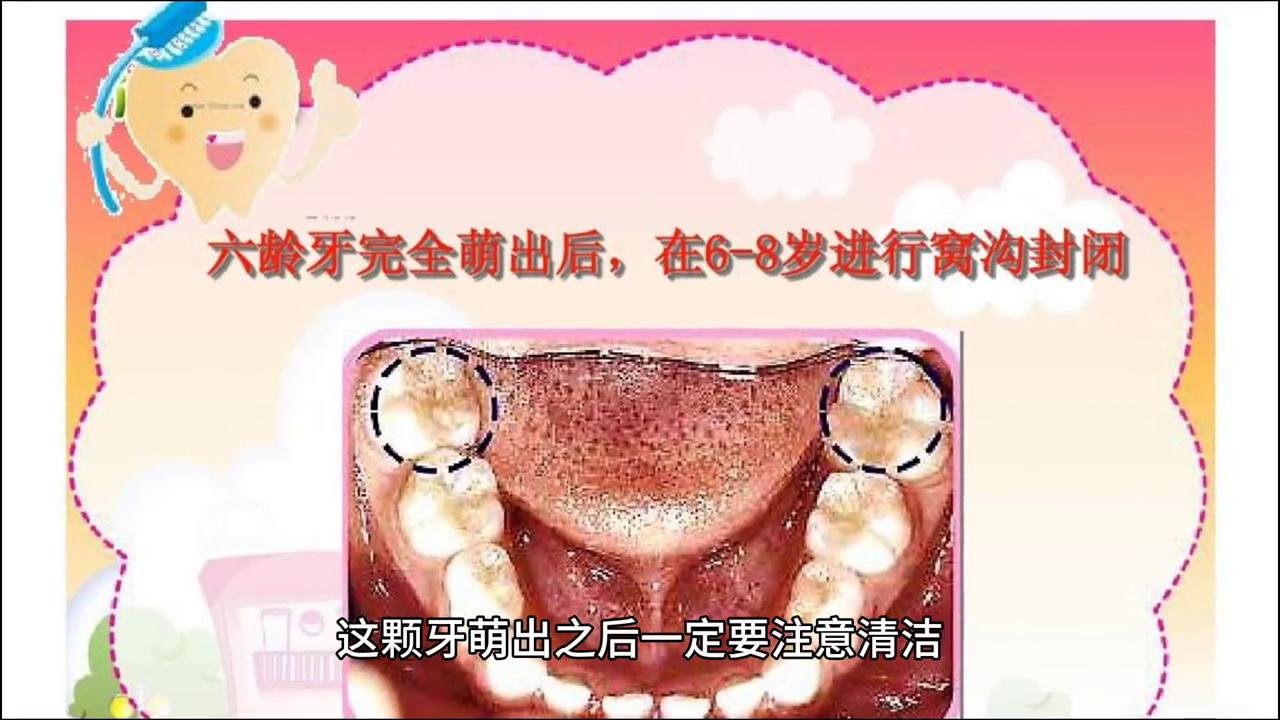 小孩换牙时长出双层牙怎么办,小孩换牙妈妈怎么引导