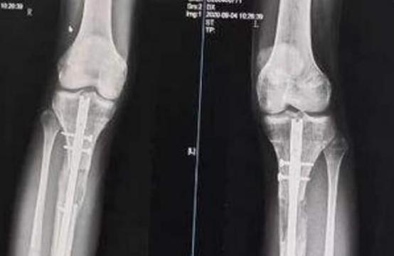 李亚诺断骨手术,断骨增高7.2厘米的李亚诺现状