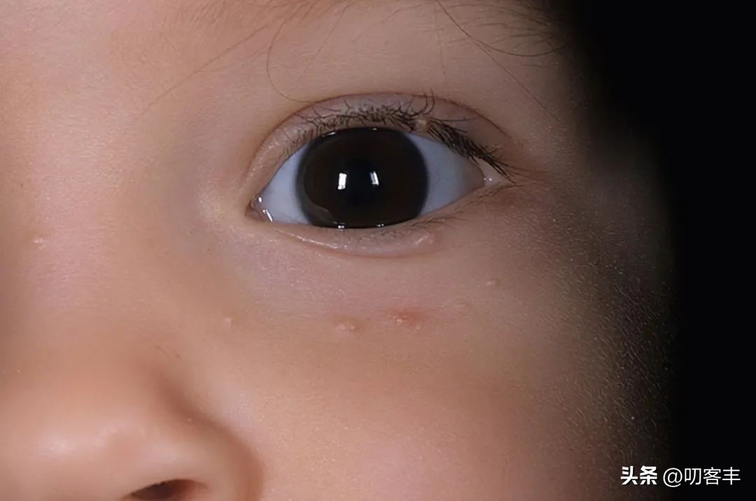 传染性软疣是hpv吗,传染性软疣的快问快答