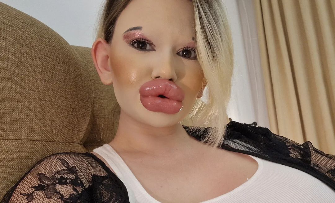 女子狂打30支玻尿酸,丰唇针建议打吗