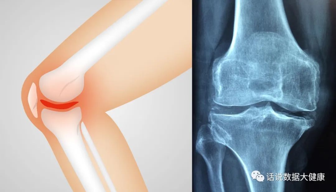 氨基葡萄糖治疗风湿性关节炎吗,骨关节炎吃盐酸氨基葡萄糖管用吗