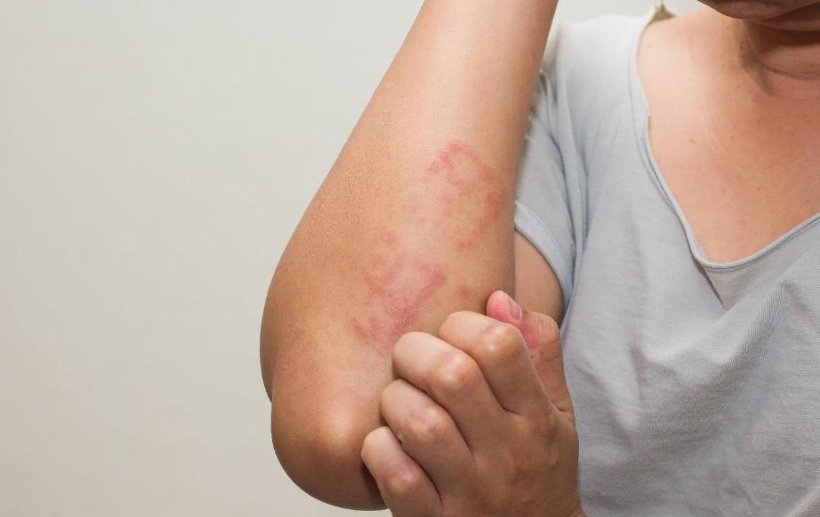 艾滋病别误以为是皮肤病,不要把艾滋病当成皮肤病