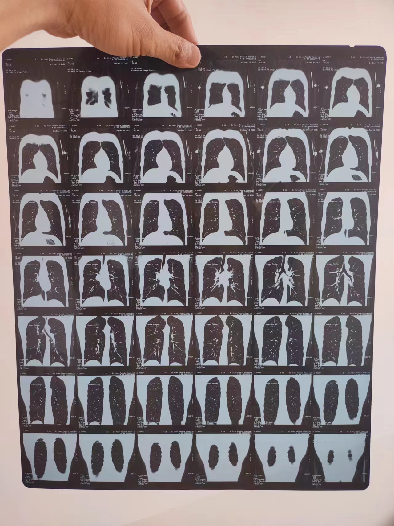 肺部ct报告单中写着阳是什么意思,关于肺部CT报告常见的6个问题