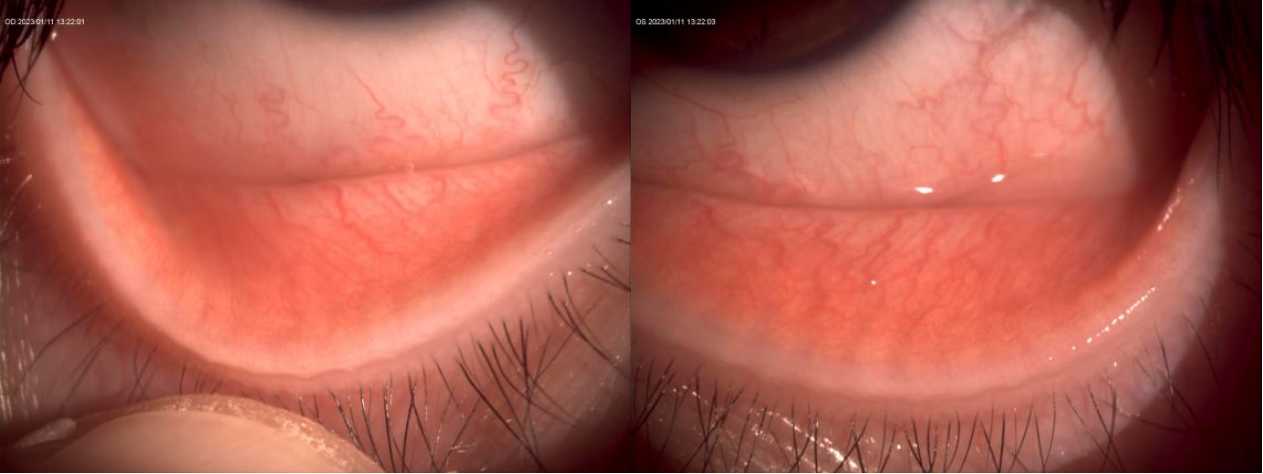 新冠引起的眼睛充血怎么治疗,新冠导致眼睛充血怎么办
