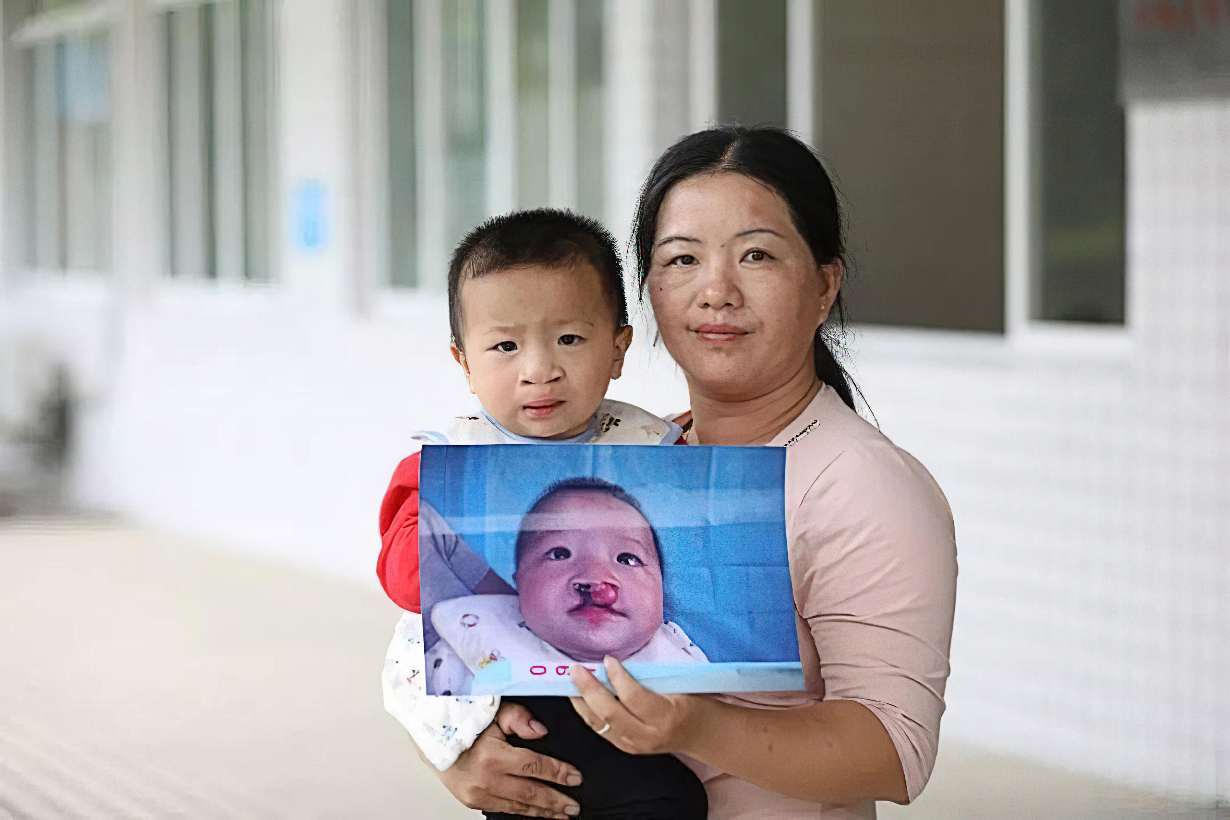 产检出胎儿唇腭裂生下来健康,42岁怀孕胎儿唇腭裂