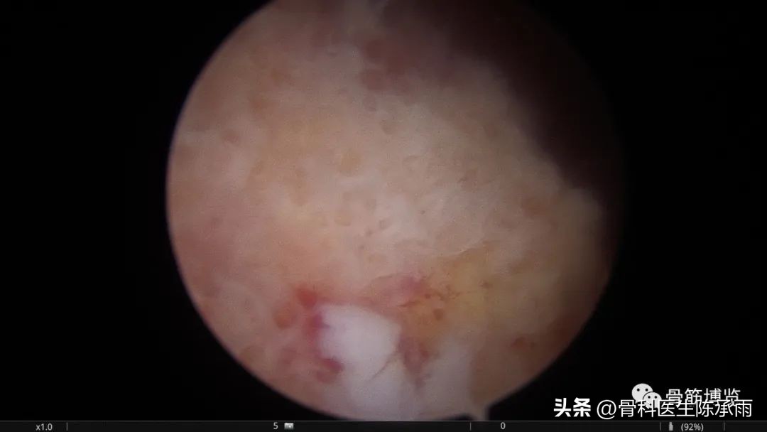 化脓性关节炎的穿刺引流治疗,关节炎镜下治疗