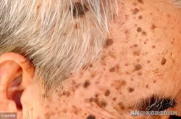 老年斑和色素沉着怎么区分,老年斑和色素沉着怎么治