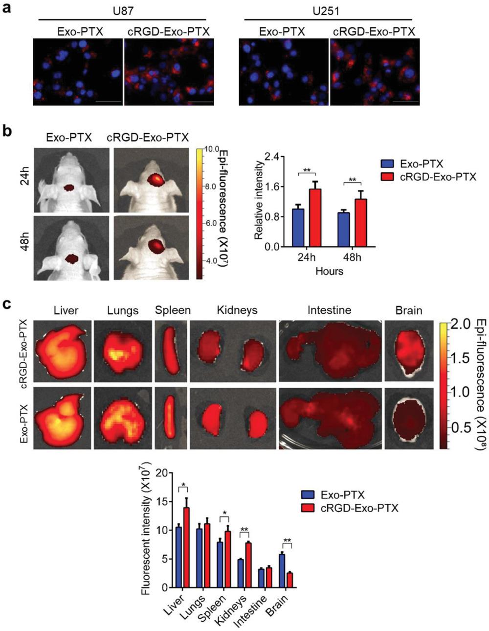 法国最新治疗胶质母细胞瘤,干细胞治疗母细胞胶质瘤