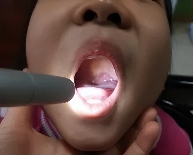 腺样体肥大的孩子手术怎么做,除了手术怎么改善孩子腺样体肥大