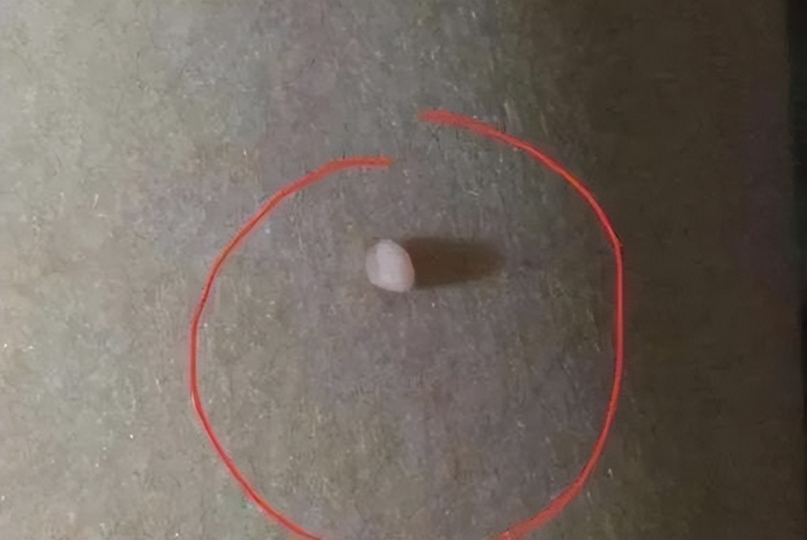 脖子上长的小肉粒可以揪掉吗,脖子和腋下的小肉粒可以揪掉吗