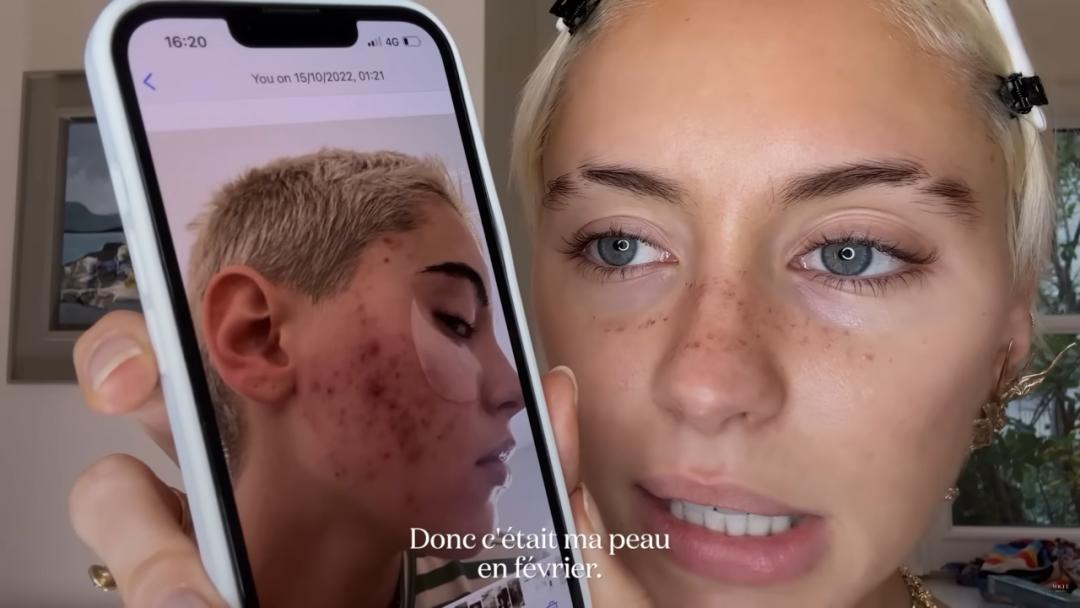 IrisLaw透露自己曾经是油痘肌，靠护肤变美！