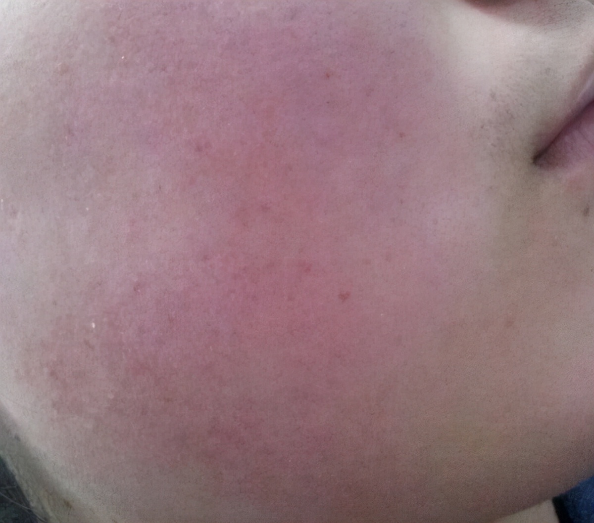 怎样去红血丝最有效的方法,怎么消除红血丝最有效