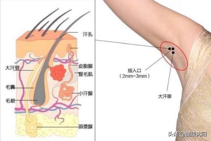 腋臭的最佳中医治疗方法,腋臭知识大全
