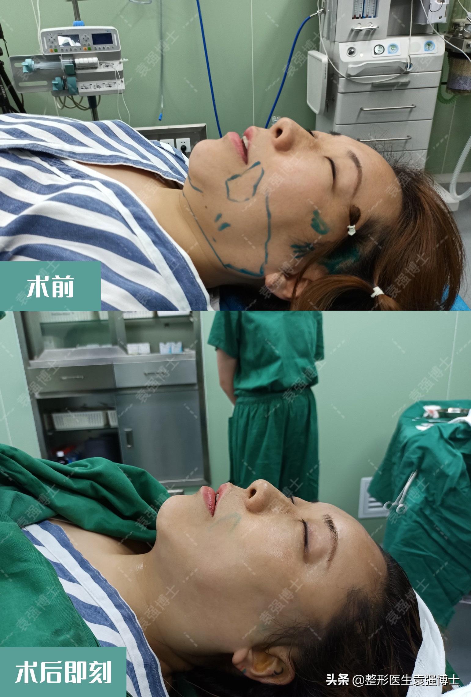 拉皮整形手术失败的案例,拉皮手术导致失败视频