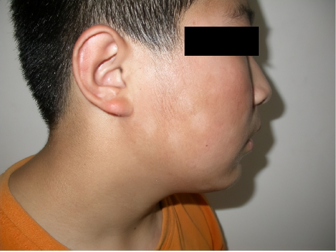 皮肤色素减退和白癜风有什么区别,白癜风是不是色素性皮肤病