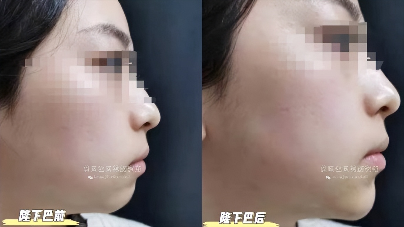 下巴不好看怎么自我改善,下巴不明显如何改善