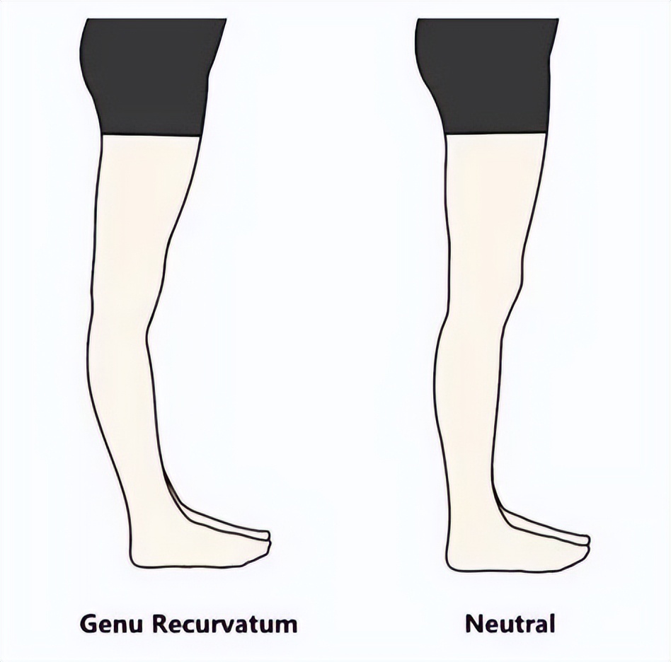 如何改善膝超伸并瘦腿,如何改善脑供血不足