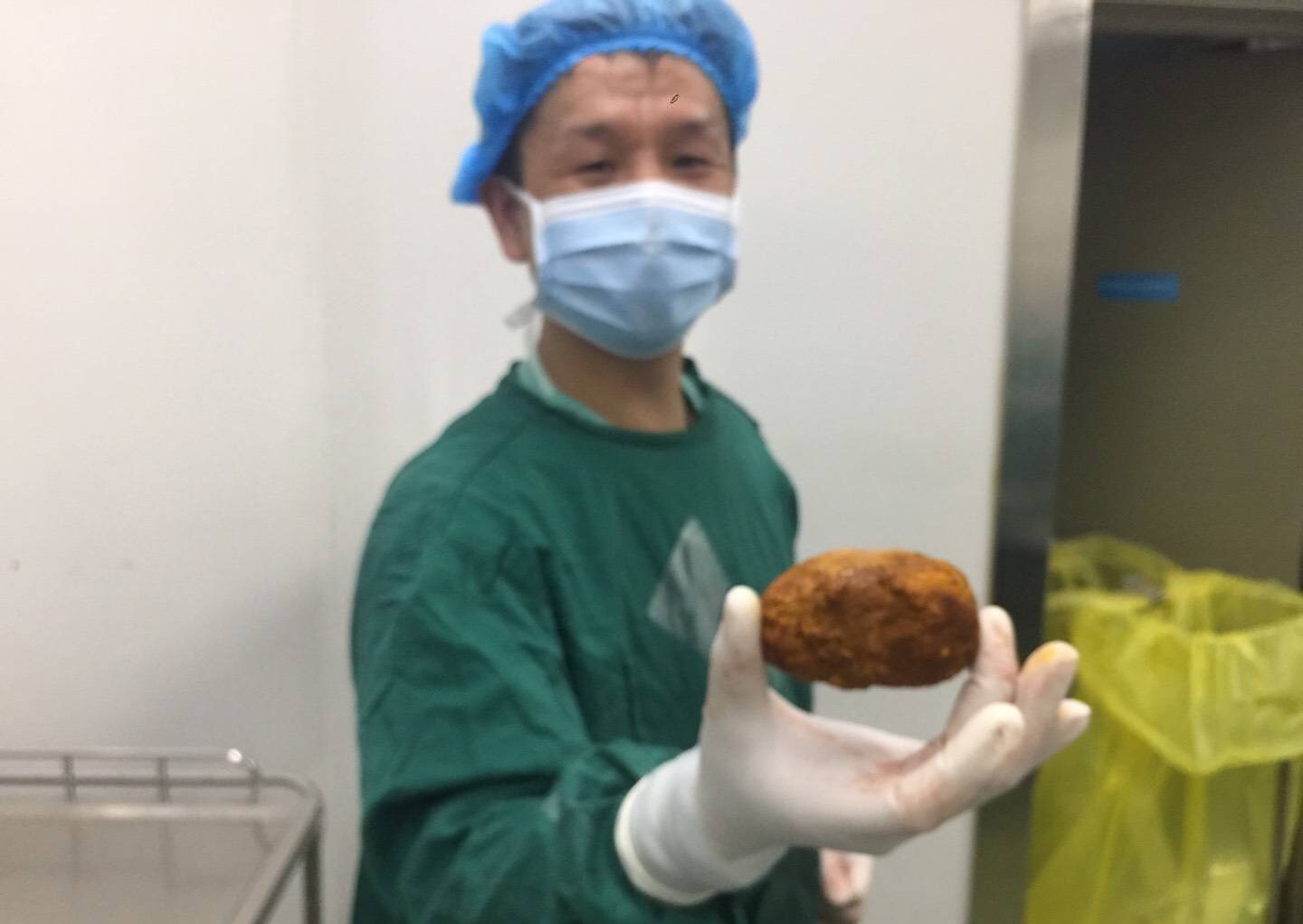 腹腔镜下胆总管切开取石治疗,充填型胆囊结石用腹腔镜怎样切除