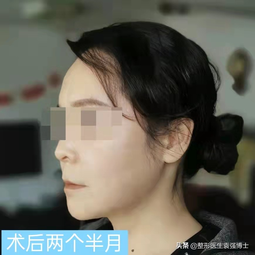 小拉皮20天恢复效果图,拉皮手术后75天复查