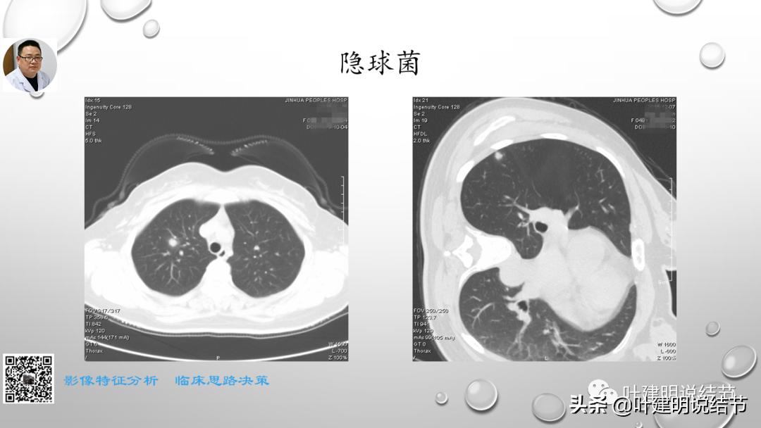 在《一脉阳光》呼吸影像诊断专题培训班上的讲课PPT（第一部分）