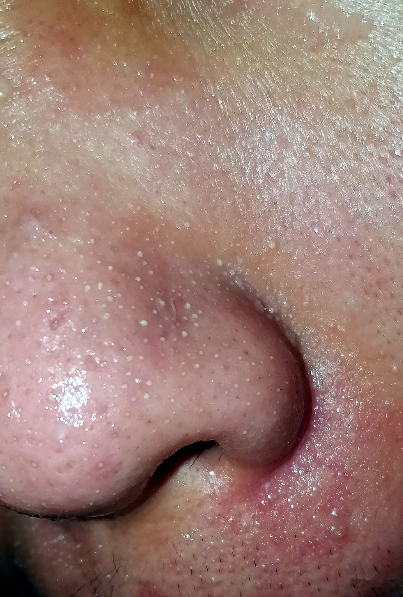 美容院护肤去黑头正常价格,小气泡去黑头美容仪器