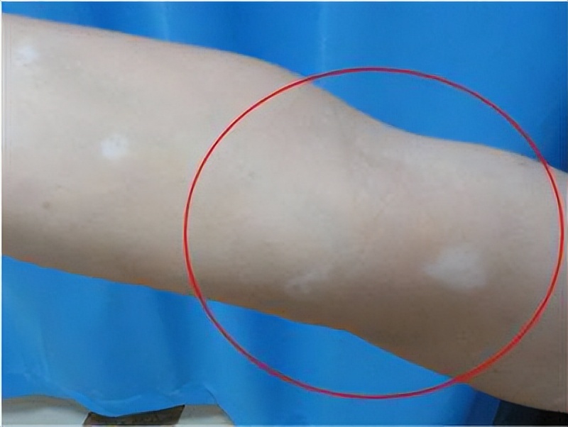 白癜风治疗最佳选择用药,各种白癜风的治疗方法