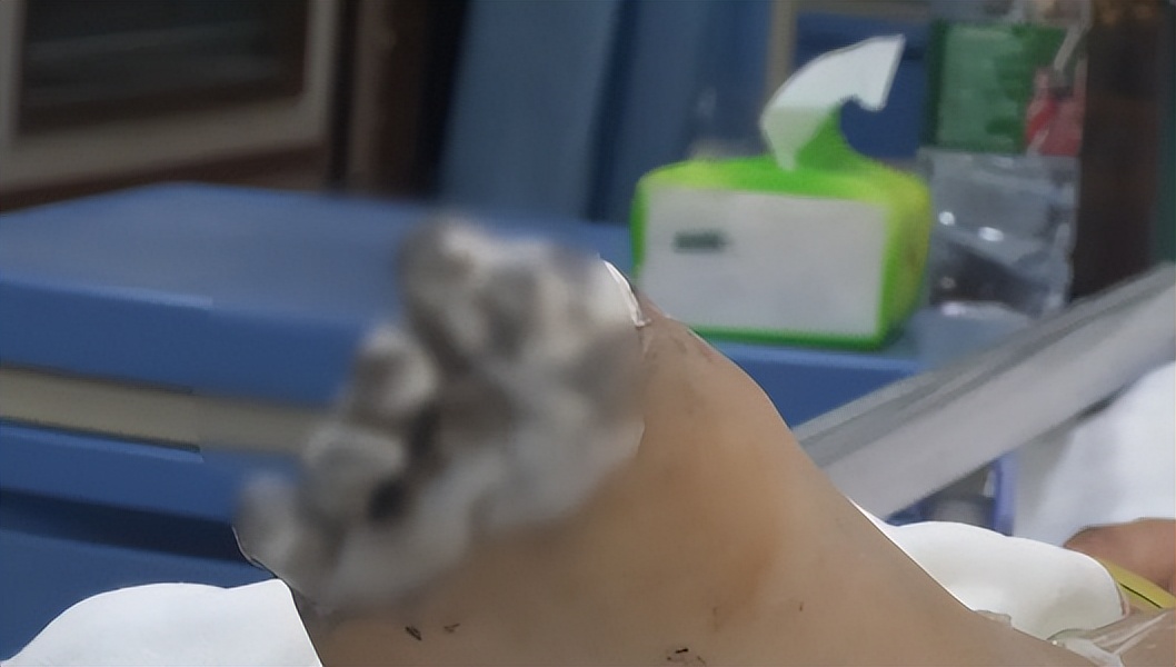 苹果充电被电到人要截肢,买iphone遭电击