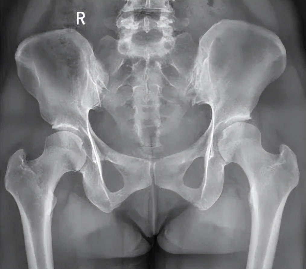 骨盆旋移症就是骨盆不正,怀疑骨盆不正查什么科