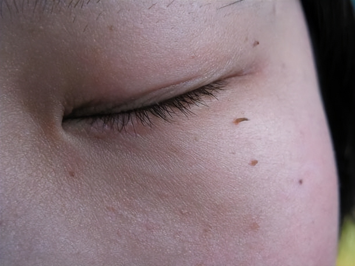 皮肤上长出肉疙瘩怎么办,皮肤上长肉疙瘩如何正确解决