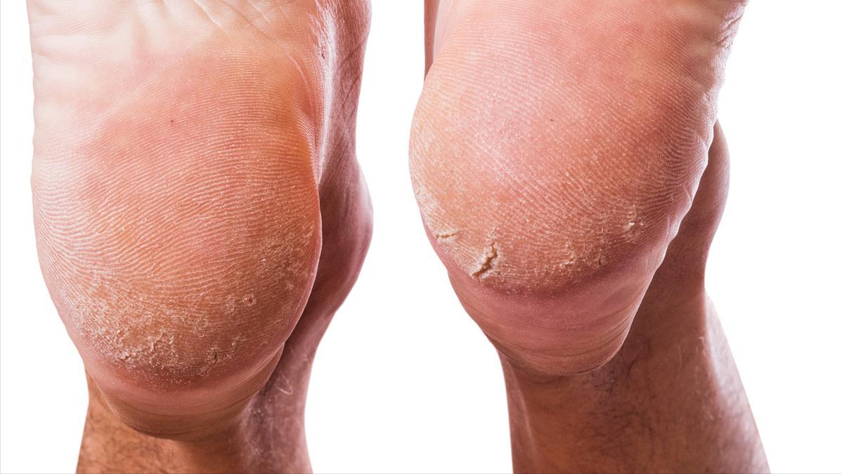 脚后跟干裂是什么原因造成的,为什么脚后跟容易干裂如何应对