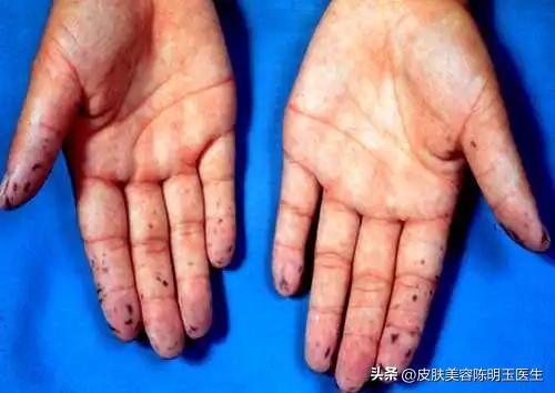 嘴唇上长黑痣好不好有啥说法,嘴唇长黑痣可以去除吗