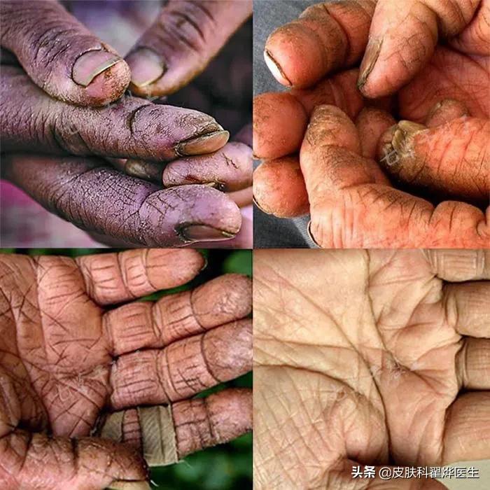 冬天父母手皲裂怎么办,冬天中老年人手脚皲裂