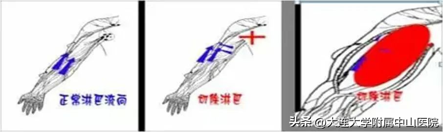 淋巴水肿脚趾怎么按摩,上肢淋巴水肿吻合术后怎样按摩