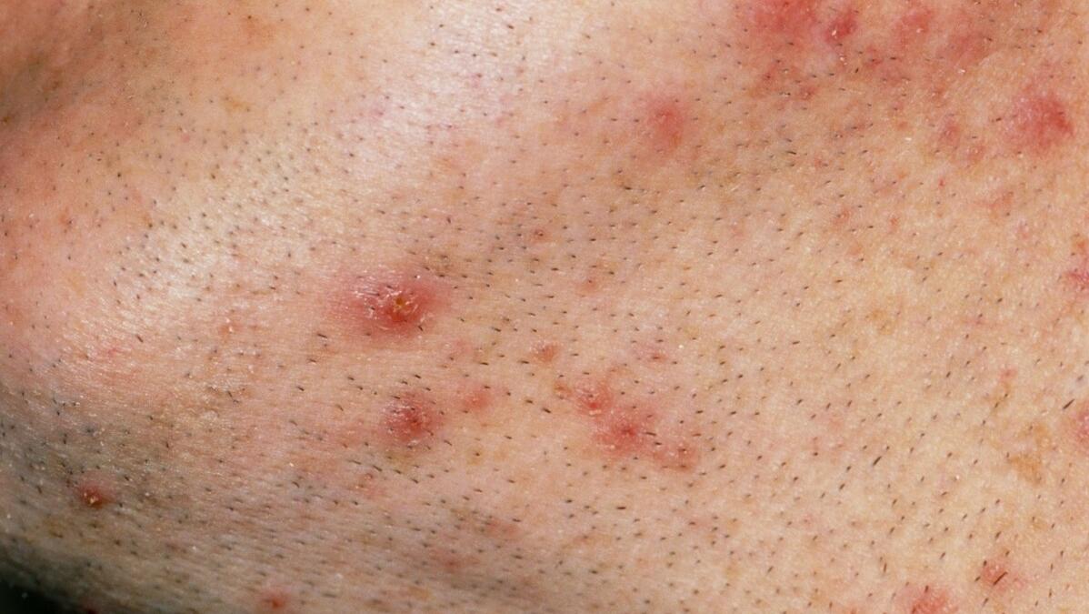 头皮长满了痘痘是怎么回事,头皮突然长痘痘是怎么回事