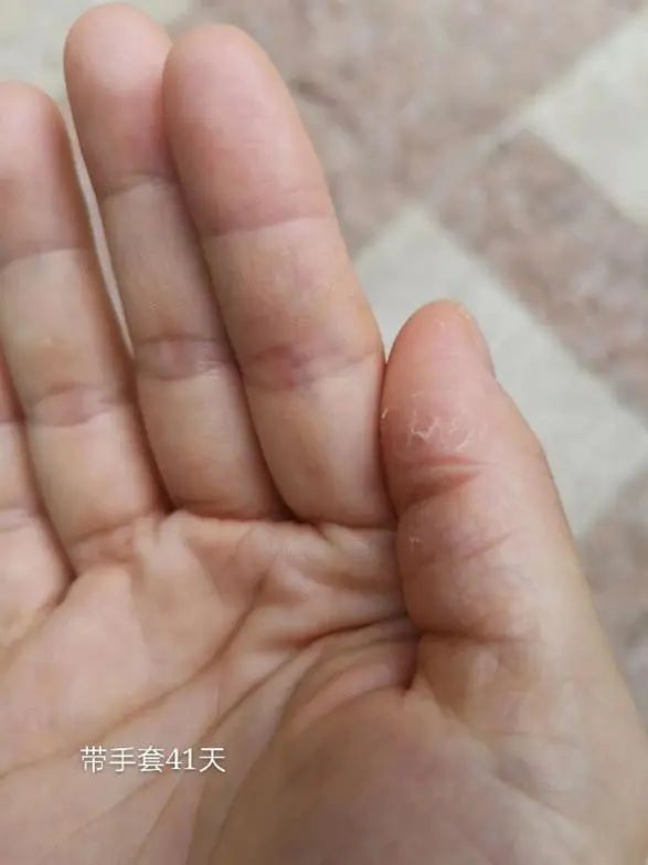 不用药祛湿疹最快最有效的方法,怎么零成本治湿疹