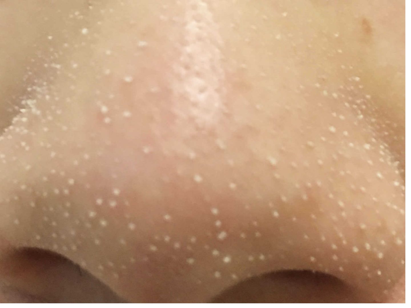 卸粉底后感觉鼻子上的毛孔有白点,为什么上完粉底液鼻子上有黑点